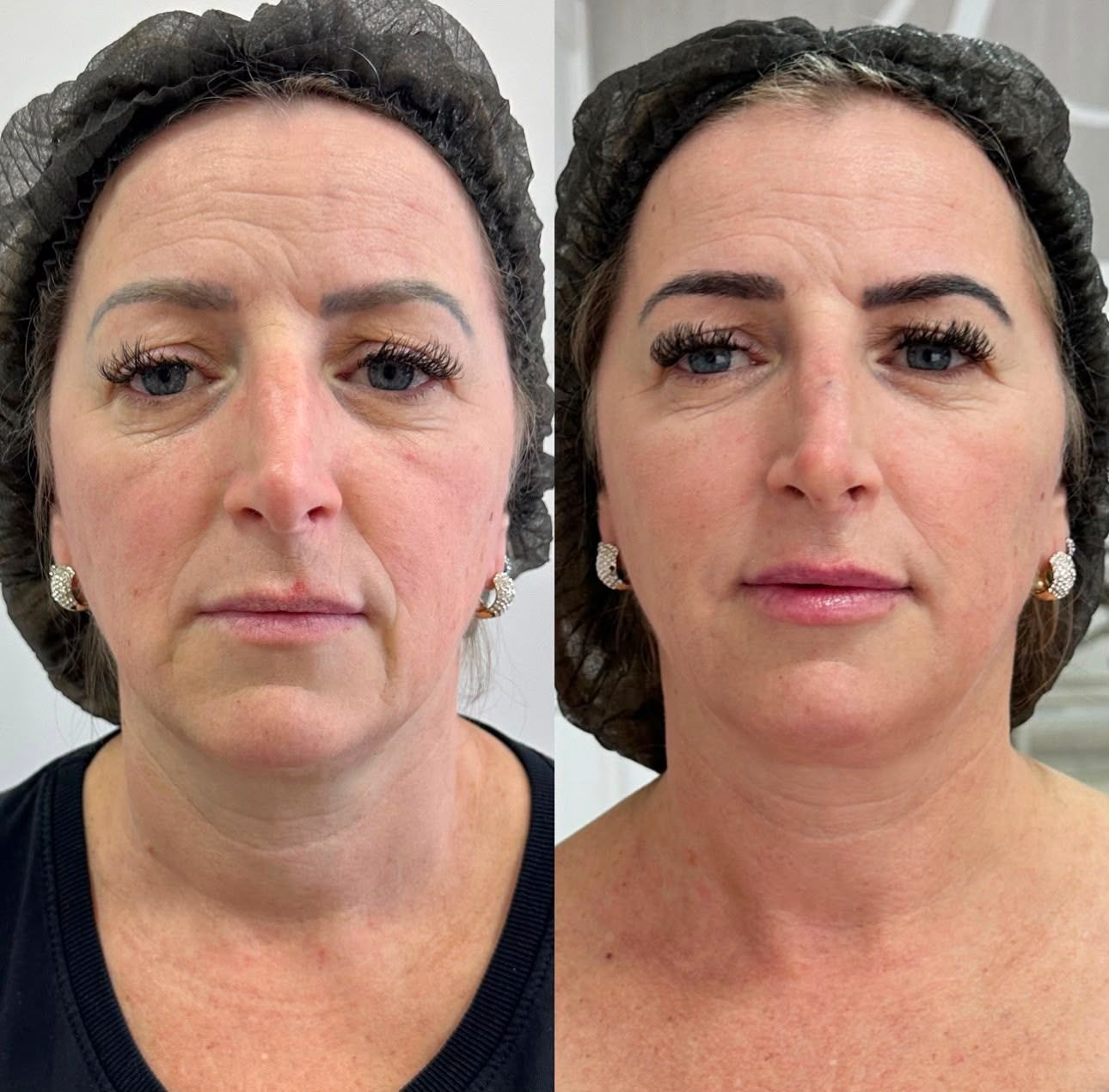 Resultado LANDEface antes e depois em vista frontal